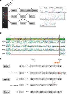 Genetic analysis of acute intermittent porphyria caused by novel classical splicing variant in the insertion region of 29-residue specific to human HMBS protein